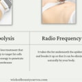 Fingernail Designs and Body Confidence: Why Radiofrequency Lipolysis Is Trending in Scottsdale, AZ